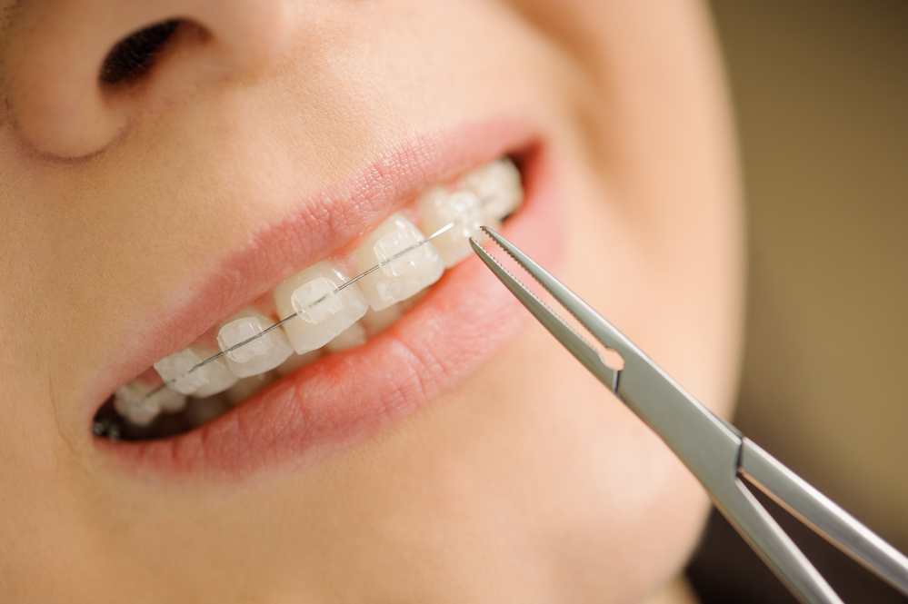 Examining the difference between clear braces vs metal braces.