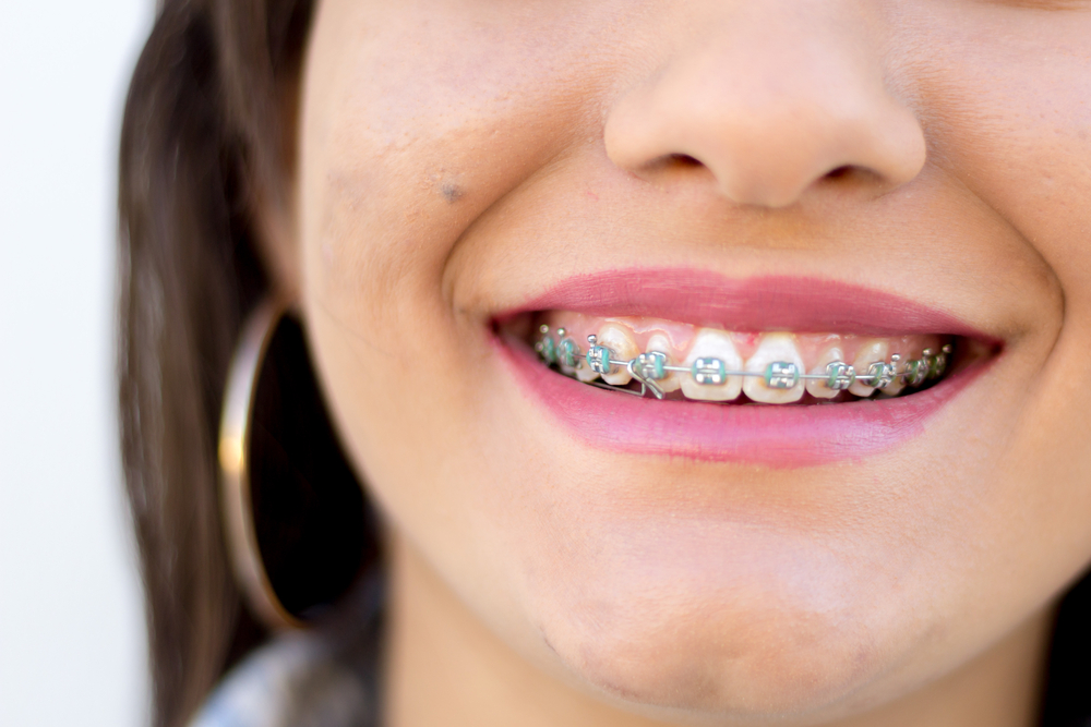 What are clear braces as opposed to metal?