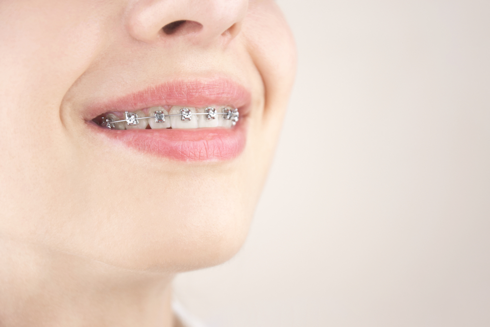 Metal braces don't set off metal detectors, so they are a popular treatment. 