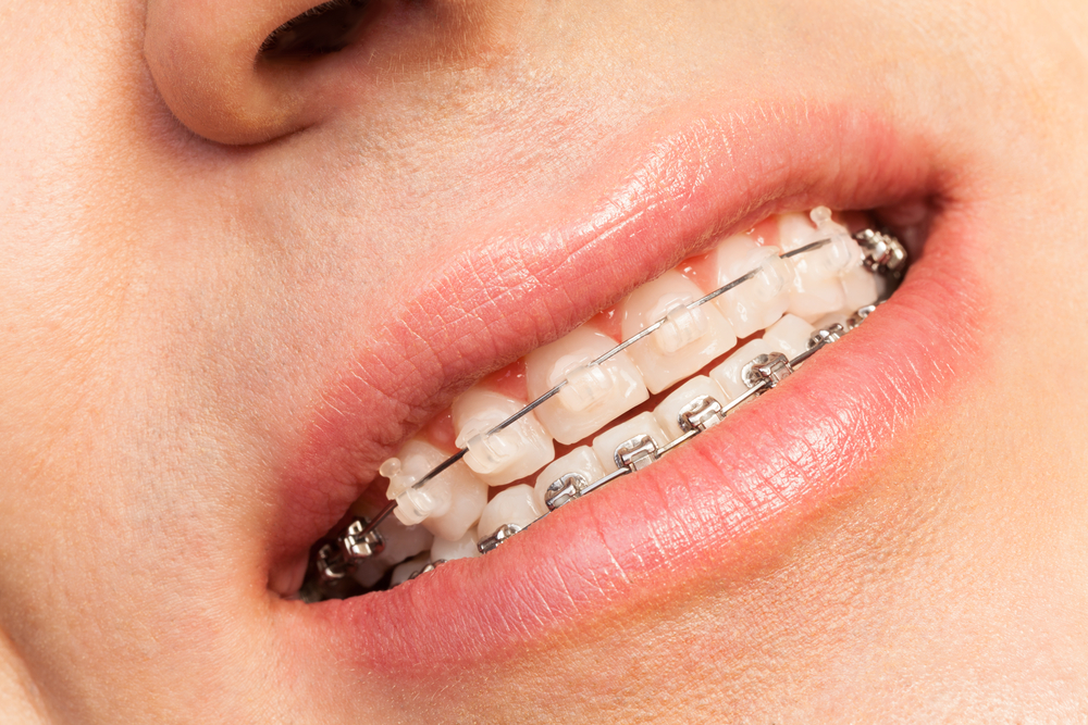 Knowing the differences between metal vs. ceramic braces can help you decide the best option.