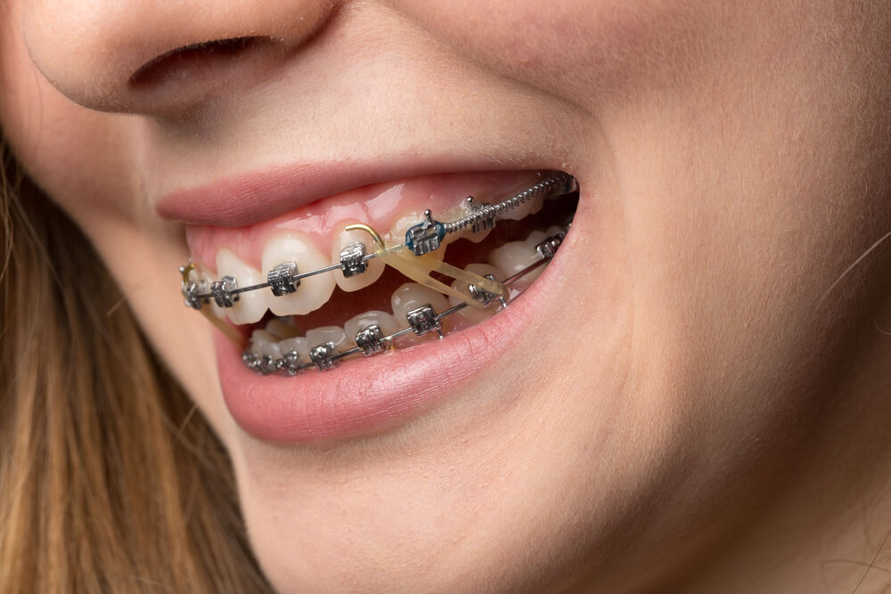 What are the differences in treatments for overbite vs underbite?