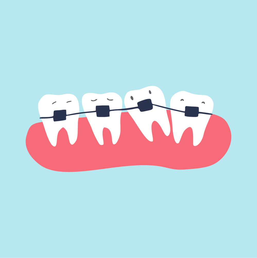 Can braces fix impacted teeth?
