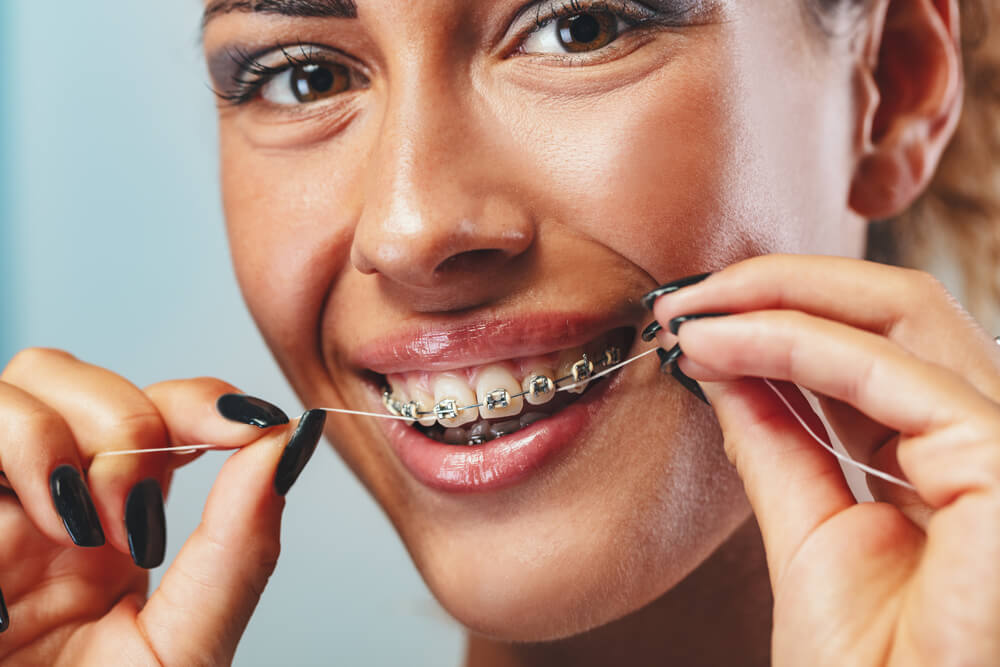 What happens if you don't floss with braces?