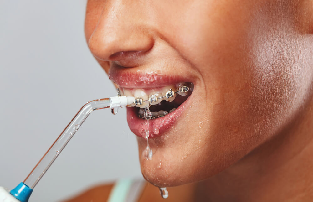 Use a water flosser instead of not flossing with braces.