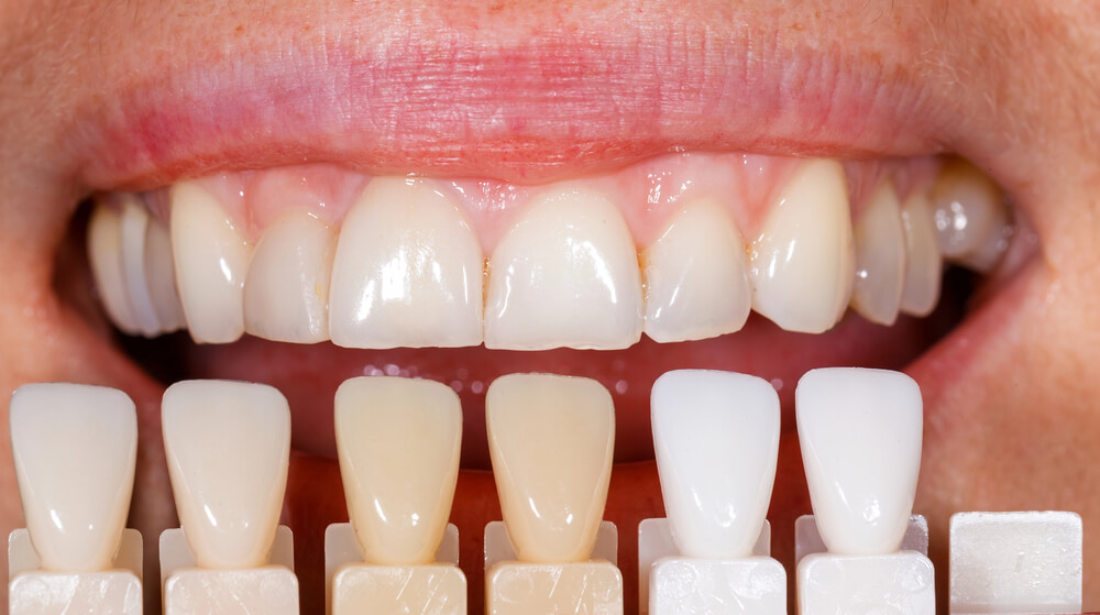 Veneers vs braces - matching tooth color for veneers.