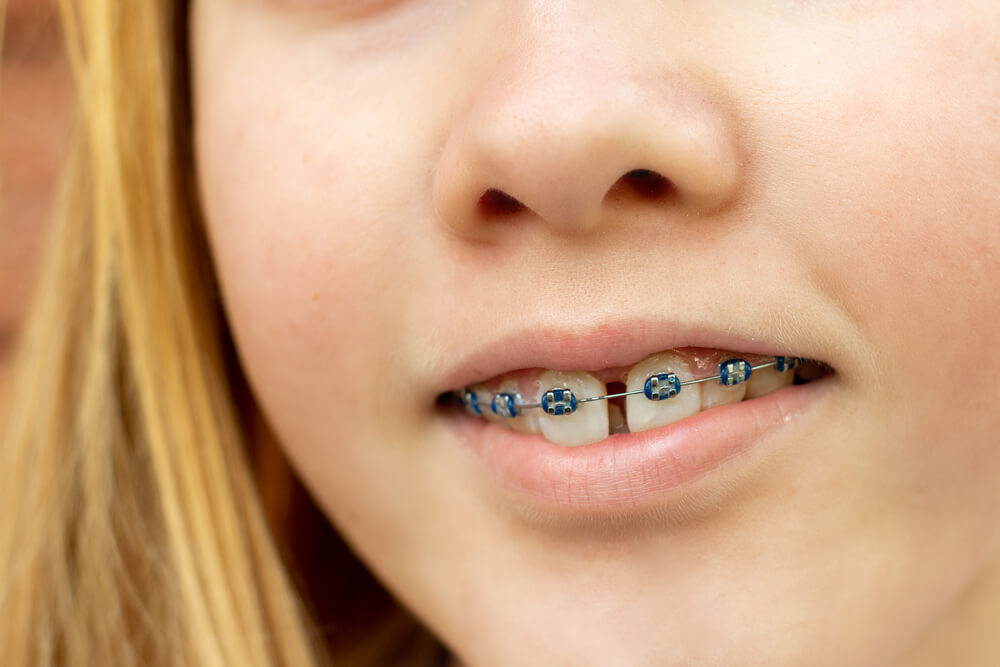 How long do braces take to close a gap?