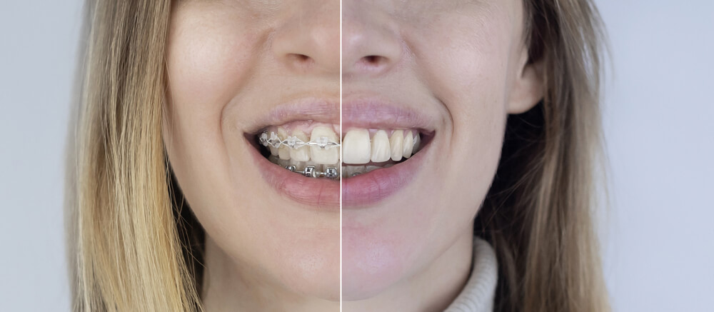 Veneers vs braces