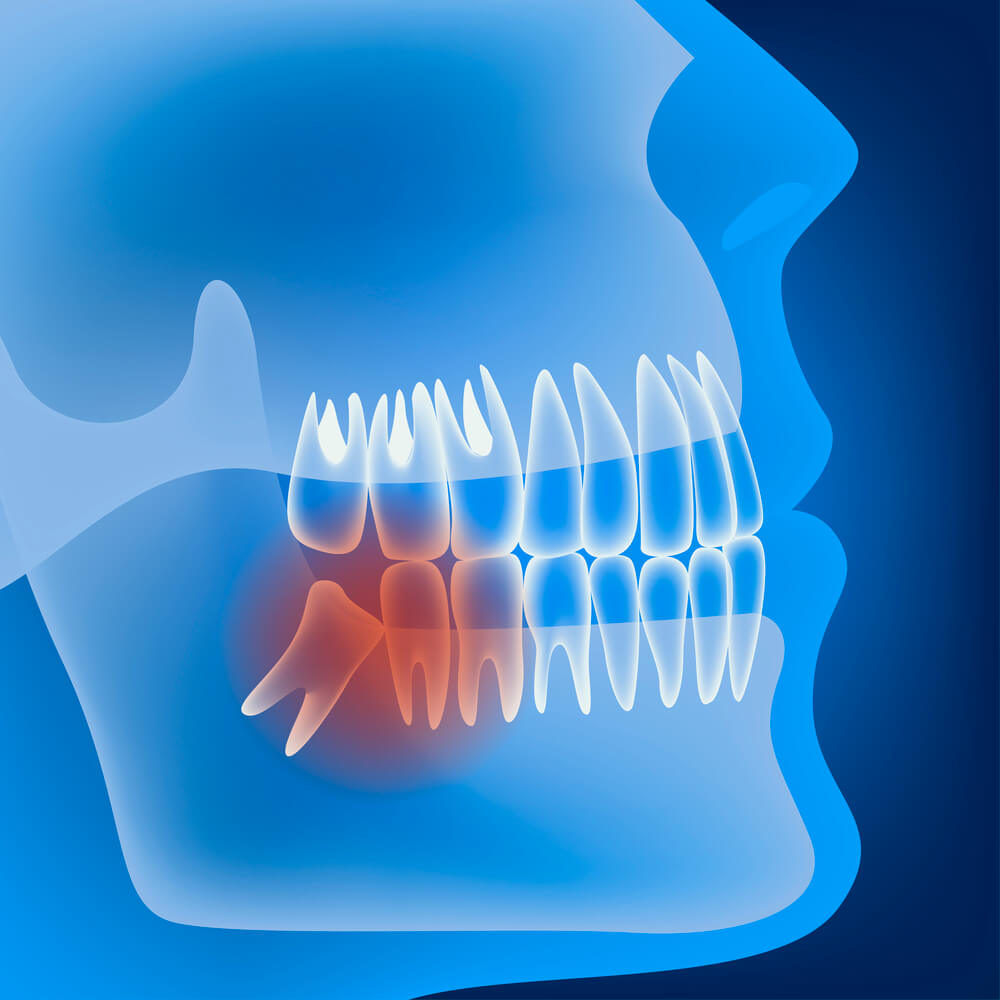 What are impacted teeth?