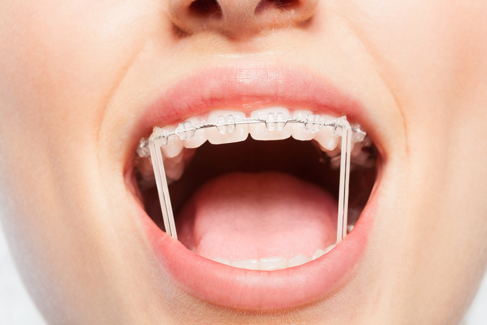 Dental elastics can be used to treat overbites.