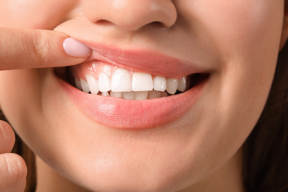 What happens to your gums if you floss too much?