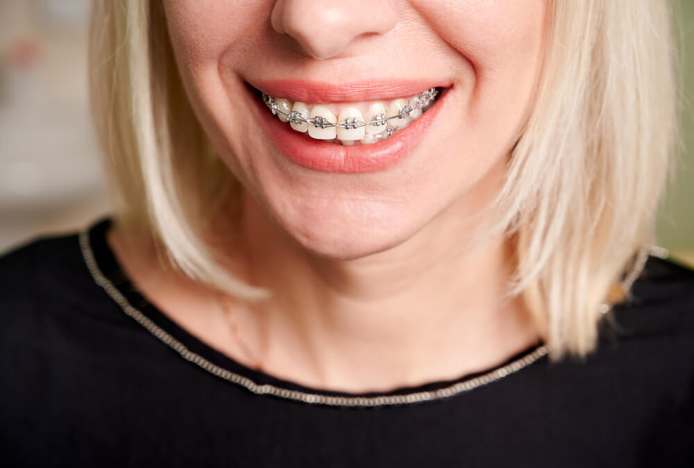 How to stop braces wire from poking without wax?