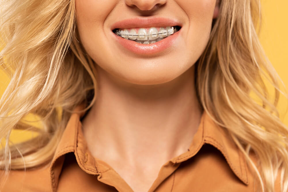 Can you get braces with cavities?