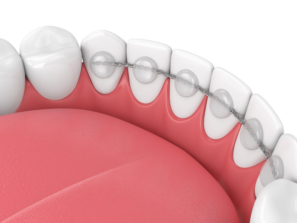 A bonded retainer is permanently affixed to the back of the teeth.