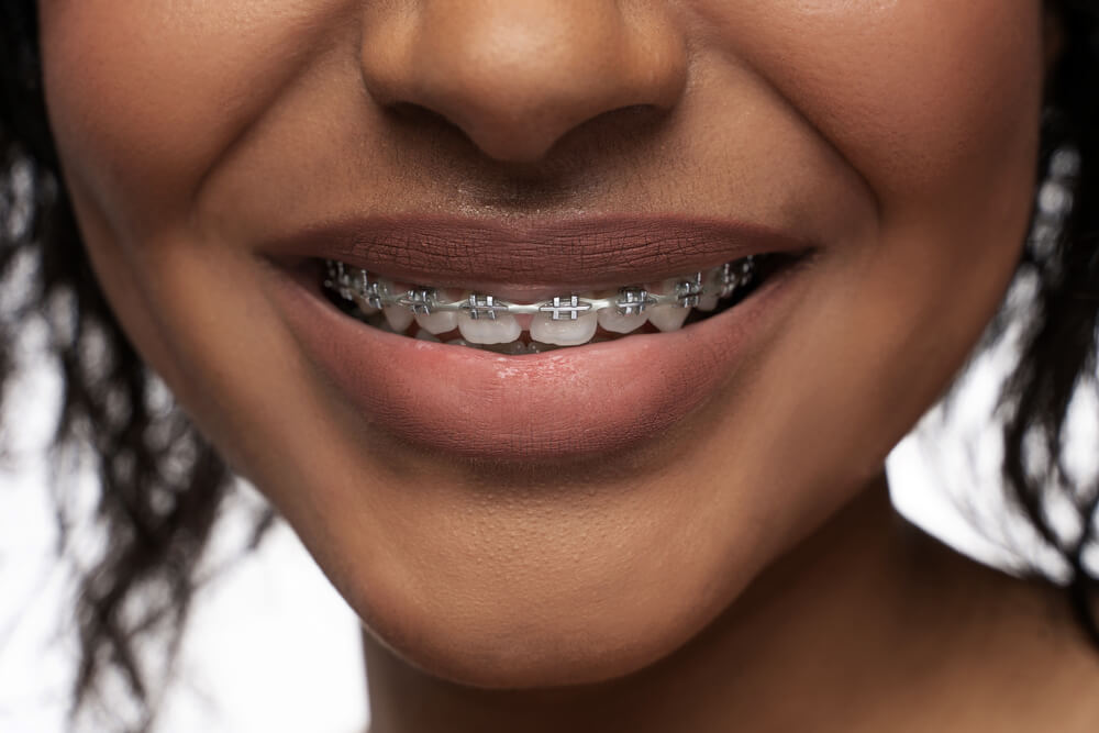 What should I do about swollen gums with braces?