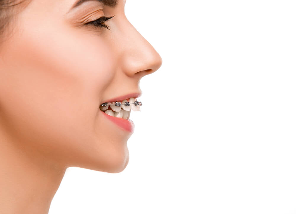 An orthodontist can help to fix overbite problems. 