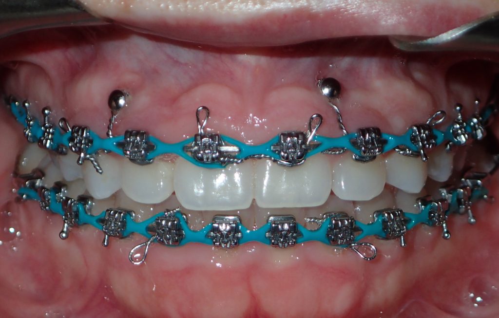 You can fix a gummy smile without surgery by using TADs and braces.