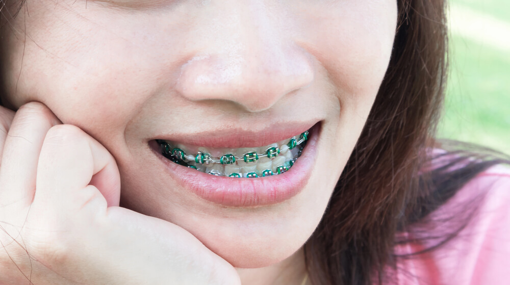 What do the elastic bands on braces do? Here's what you need to know!