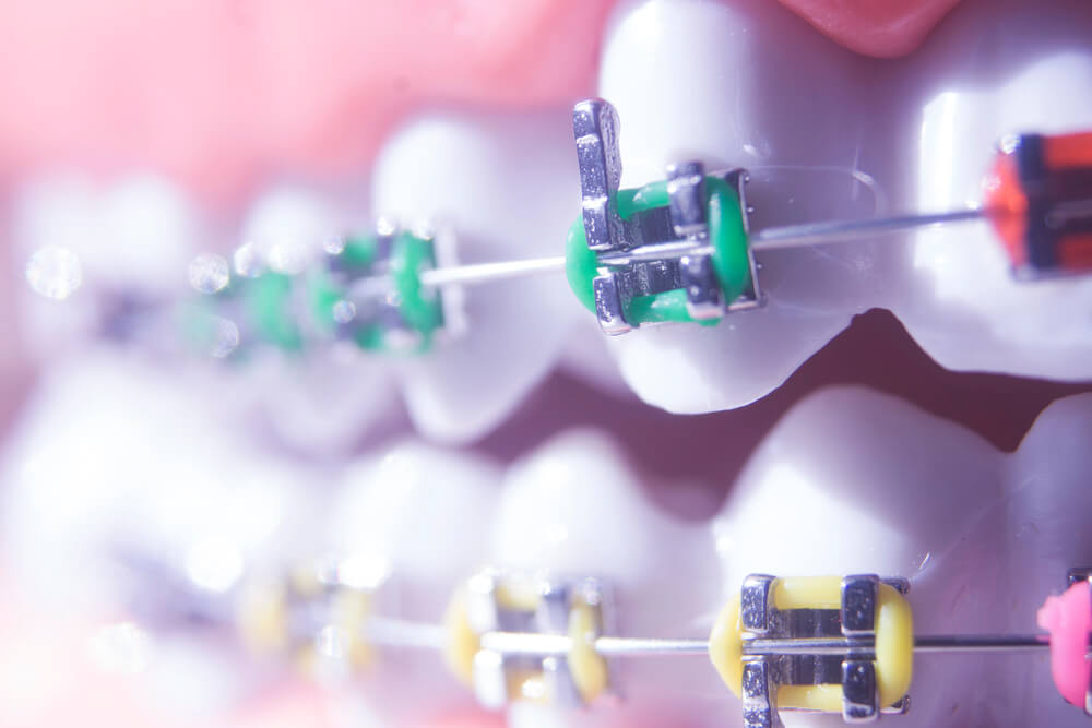 What color elastics for braces are best?