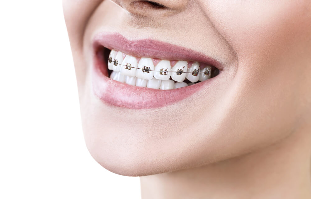 Queen Creek orthodontics can be affordable with the Peterson Family Orthodontics.