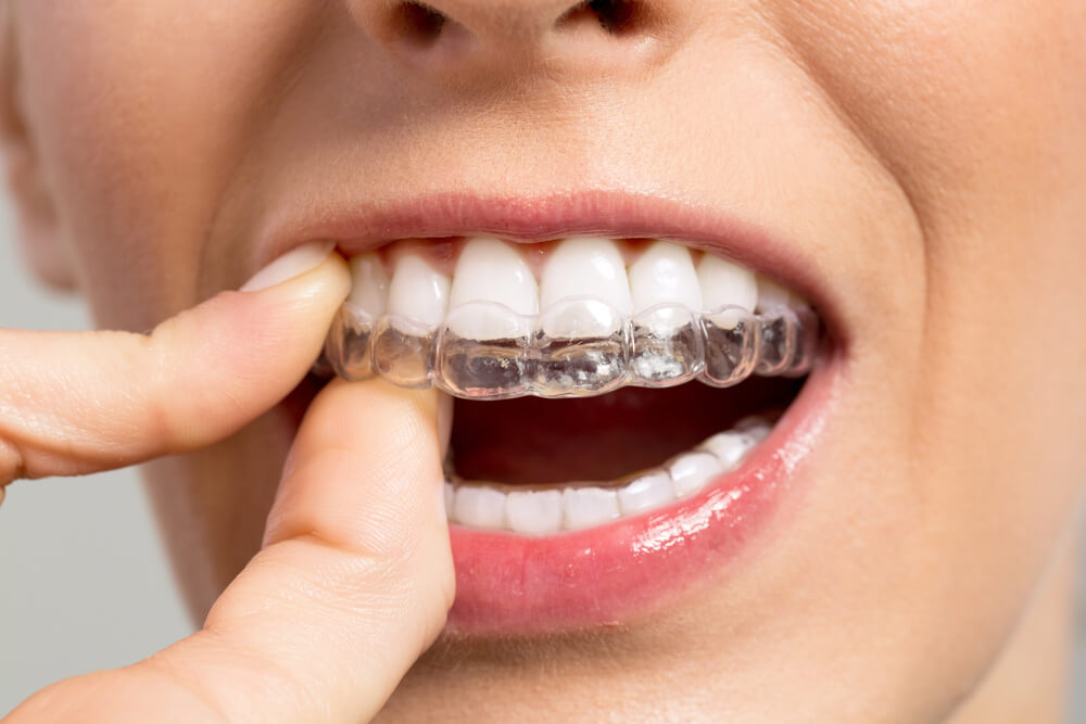 Here are the pros and cons of clear aligners vs. braces.