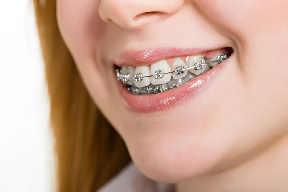Peterson Family Orthodontics is a great choice for those living in the Florence, AZ area.