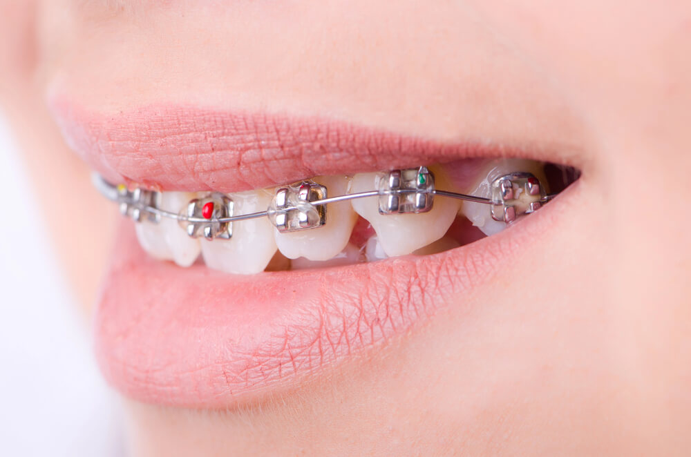 Are clear aligners better than braces?