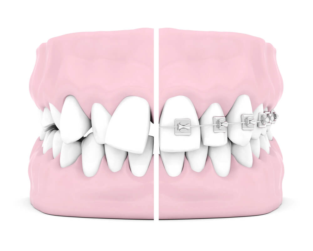 Here is one of the best places for braces in Florence AZ.