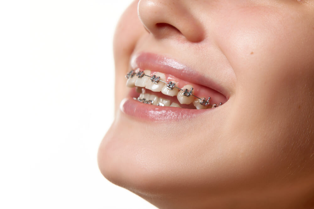 Here are 5 of the best places for braces in Florence AZ.